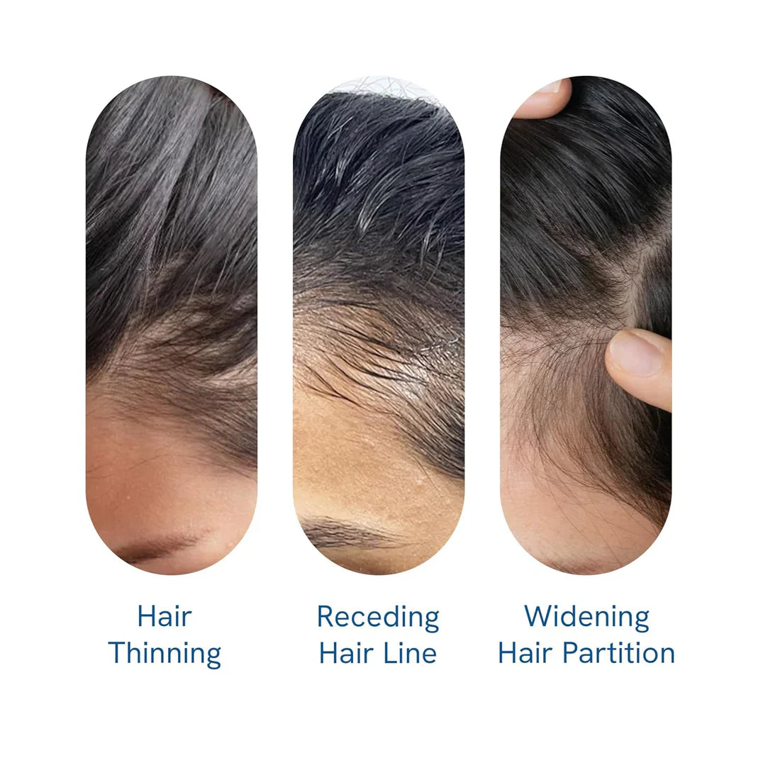 Be Bodywise Advanced Hair Growth Roll-On Serum | 3% Rosemary | 2% Aminexil | 3% Redensy l 2% Anagain | Precision Scalp Applicator | Paraben & Sulphate Free | Non oily and mess free-HQY
