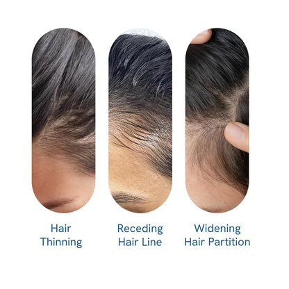 Be Bodywise Advanced Hair Growth Roll-On Serum | 3% Rosemary | 2% Aminexil | 3% Redensy l 2% Anagain | Precision Scalp Applicator | Paraben & Sulphate Free | Non oily and mess free-HQY